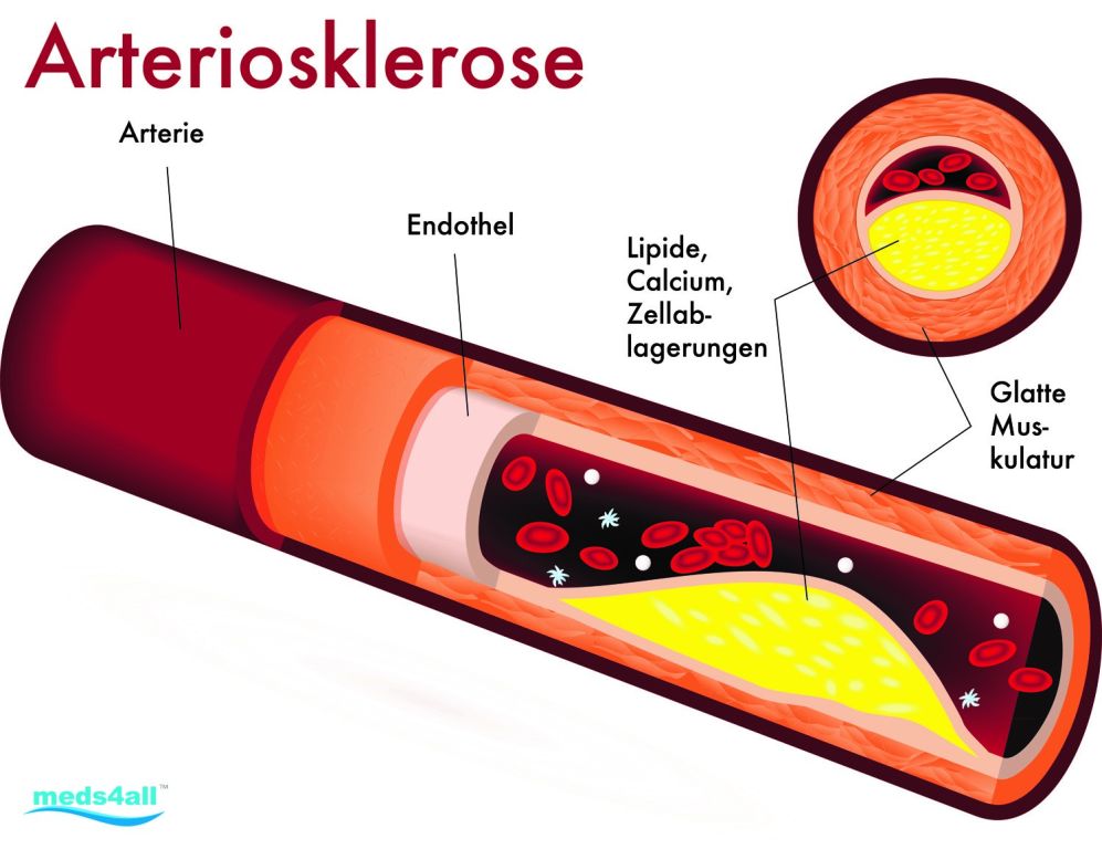 Wundermittel Knoblauch gegen Arteriosklerose - Bildrechte: http://www.meds4all.com/ch/