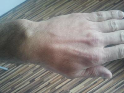 Ganglion
