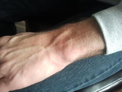 Ganglion nachher