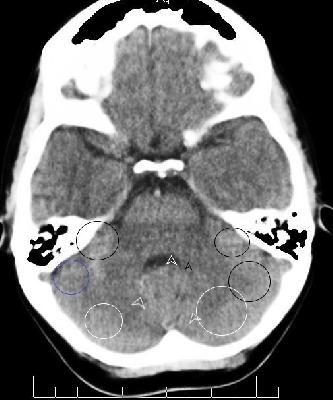 Cerebellum_Pons