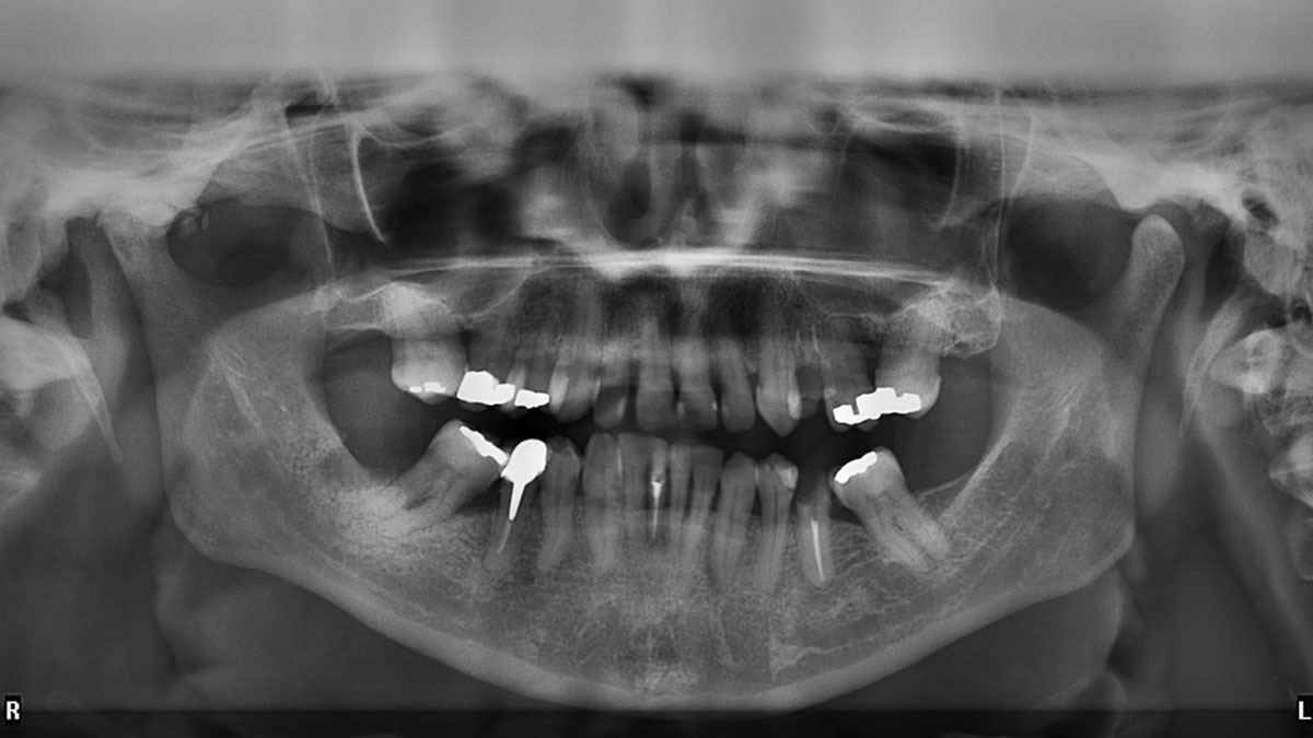 Zähne Röntgenbild
